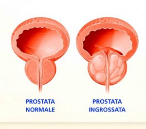 post it  prostata